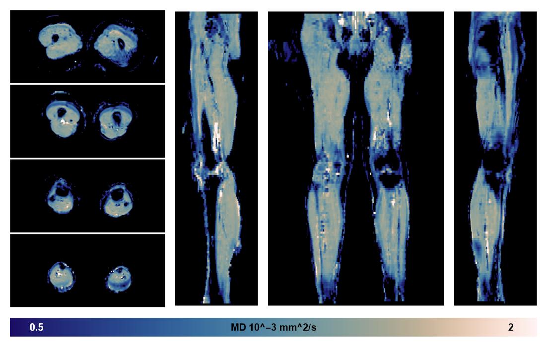 IVIM corrected whole leg muscle mean diffusivity obtained from diffusion tensor imaging.